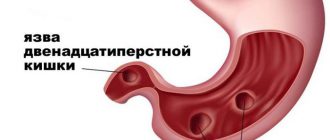 Язвенный гастрит желудка: симптомы, лечение, диета